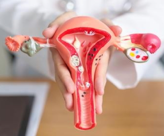 L’endométriose : c’est quoi ?